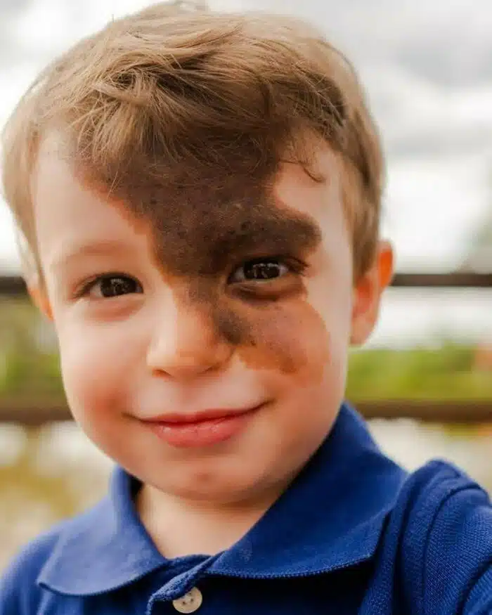 Birthmark